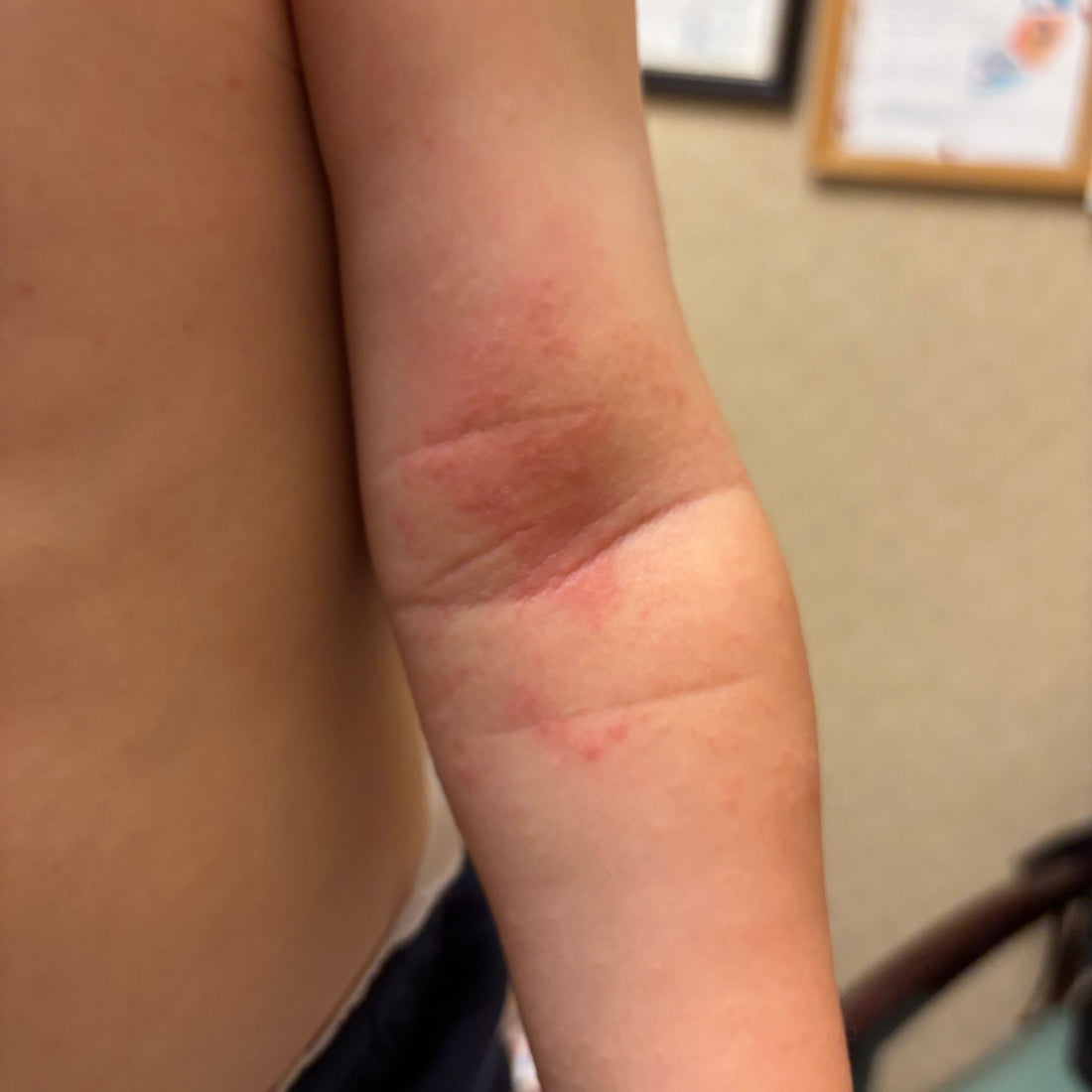 How We Finally Treated Our Son's Eczema (And Created a Bundle to Help Other Parents)