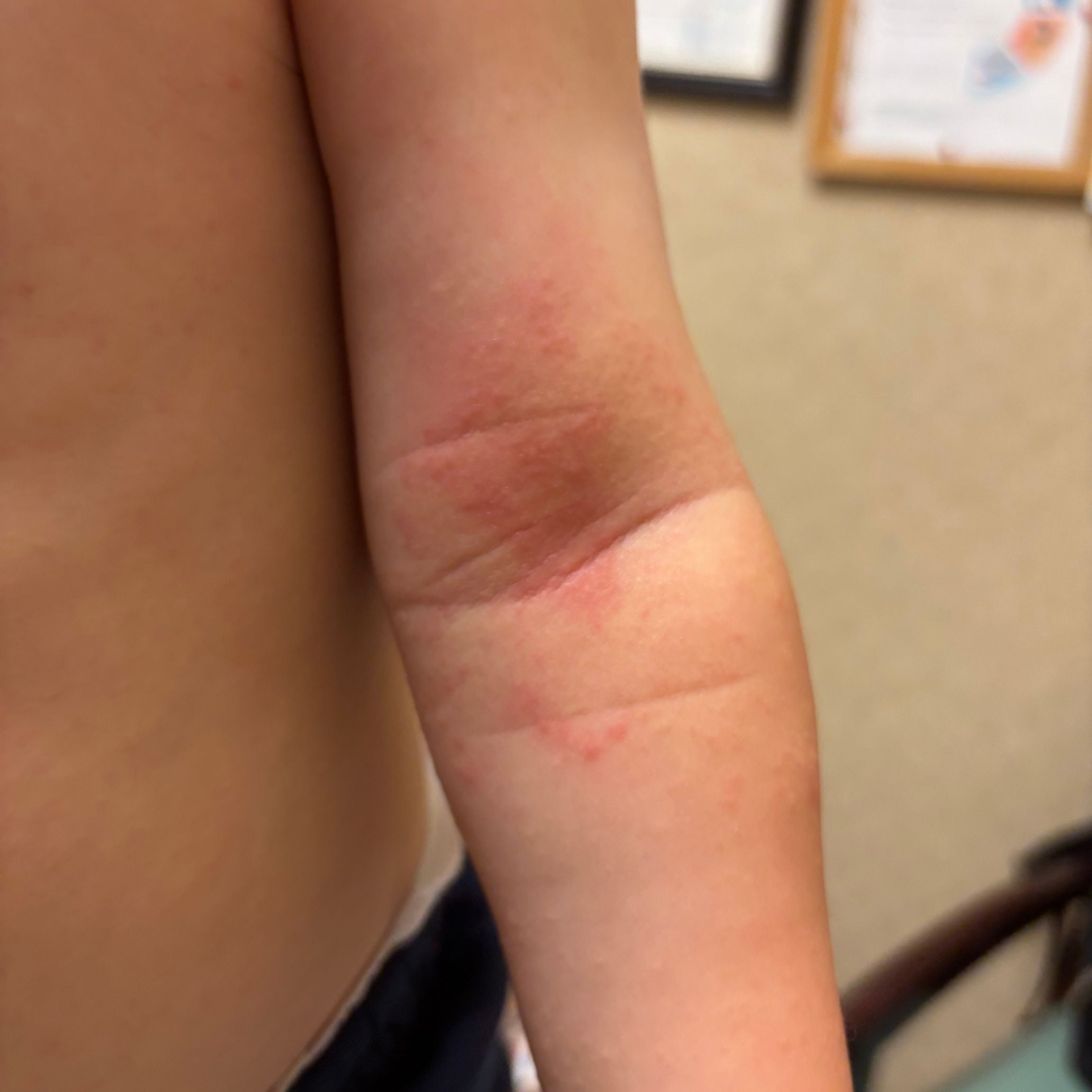 How We Finally Treated Our Son's Eczema (And Created a Bundle to Help Other Parents)